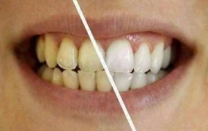 risultati ed effetti denta black