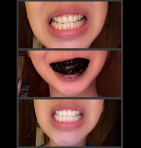 denta black effetti e risultati